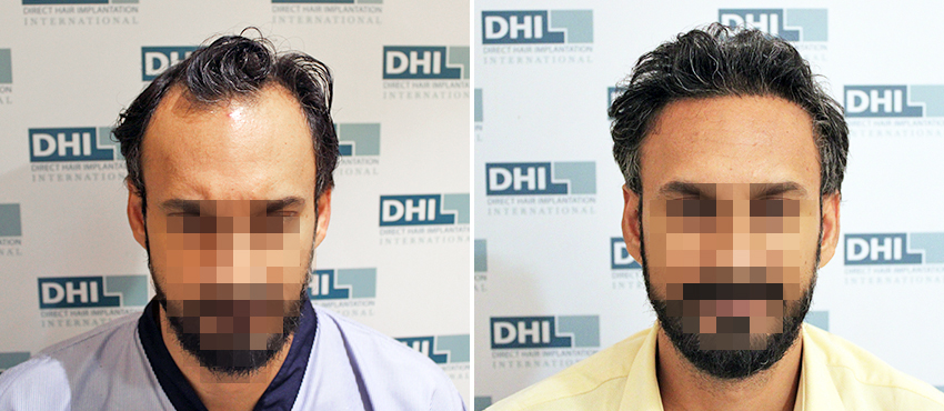 DHI before & after hair transplant results